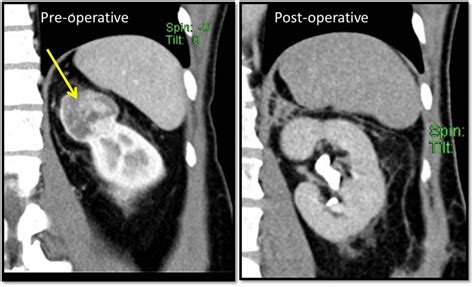 Renal oncocytoma – Radiology Cases