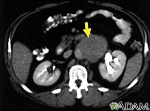 Abdominal CT scan Information | Mount Sinai - New York