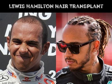 Lewis Hamilton Hair Transplant - Hair Loss & Technical Analysis