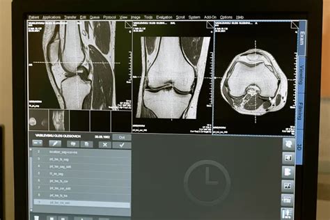 Understanding Greenstick Fractures in Children: Causes, Symptoms, and ...