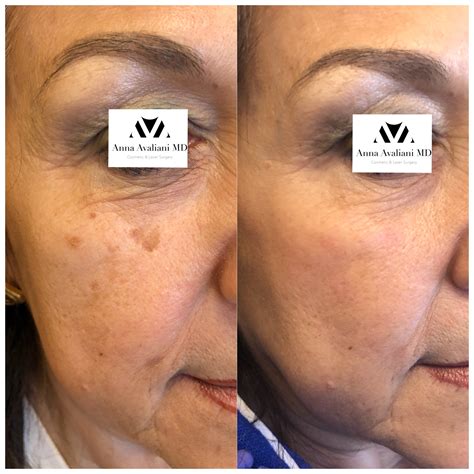 Best Melasma treatment on the market is PicoSure Focus! - Anna Avaliani ...