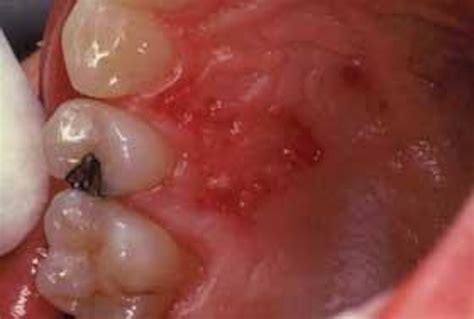 Shingles | Registered Dental Hygienist