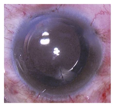 Patient 1 with iris posterior synechiae and corneal suture. (a ...