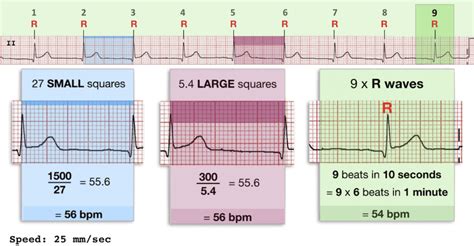 Ecg Heart Rate Calculation