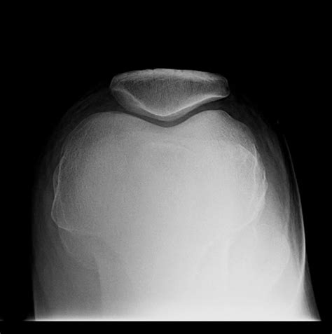 Patella Fracture Sunrise