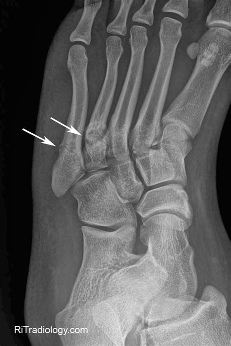 Xray Of Foot Stress Fracture