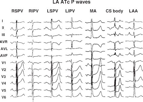 Table 3 from P-wave morphology in focal atrial tachycardia: development ...