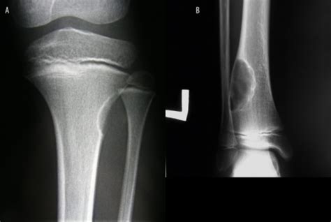 Cortical fibrous defect versus non-ossifying fibroma. ( | Open-i