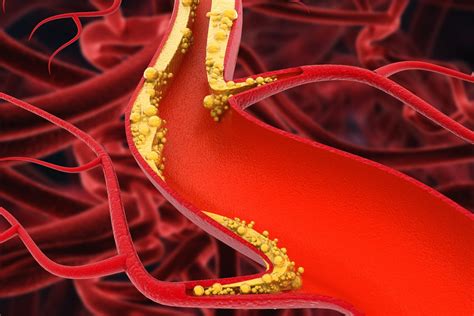 Atherosclerosis: Causes, Symptoms, and Treatment Innovations