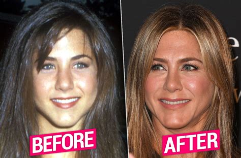 Jennifer Aniston Nose Job Before After