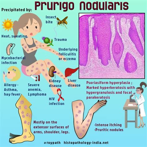 Prurigo Nodularis | Intense itching, Pathology, Skin disorders