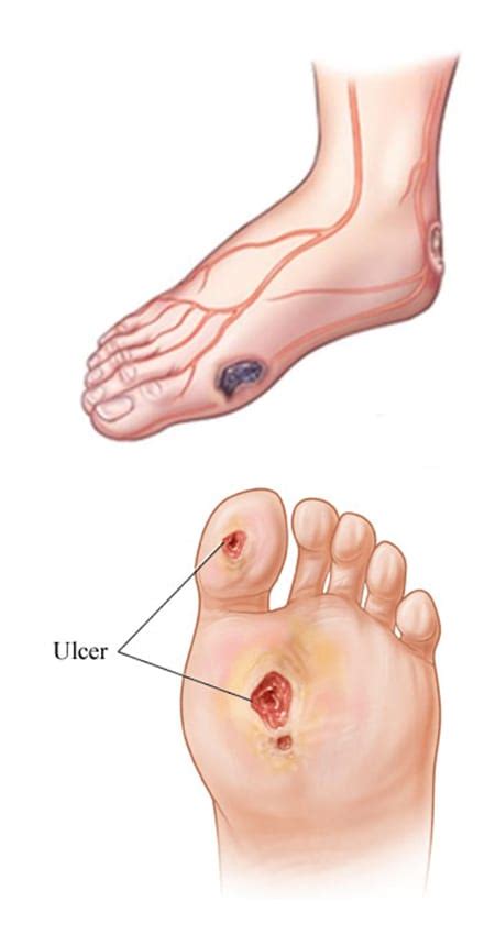 Arterial Leg Ulcers - Center for Advanced Cardiac and Vascular ...