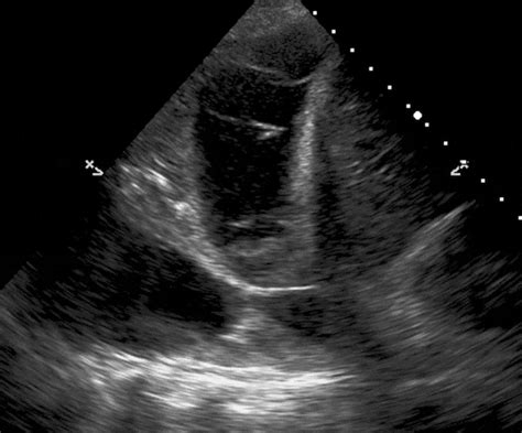 Loculated Pleural Effusion / Chest X-ray Shows Cardiomegaly With ...