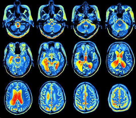 FDG PET Scan More Accurately Assesses Severity of Cognitive Decline in ...