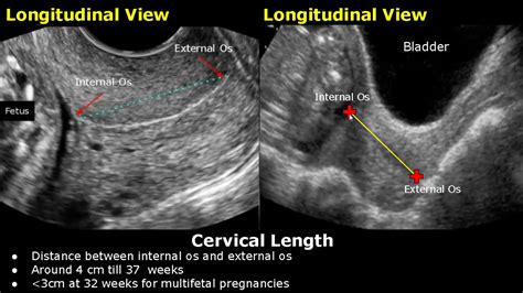 How To Measure Cervical Length On Ultrasound | Transabdominal And ...