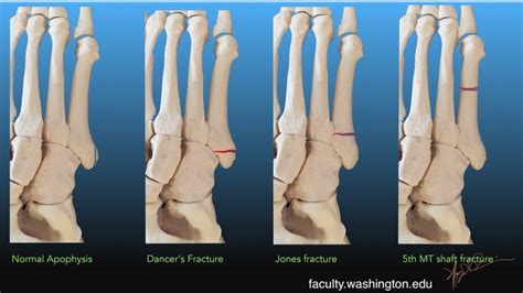 5th metatarsal fracture — Maimonides Emergency Medicine Residency