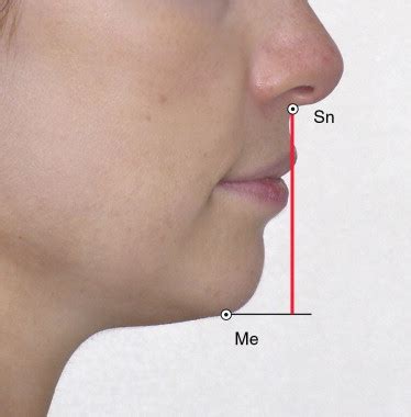Dimensión vertical oclusal, medida desde Subnasal a la proyección ...