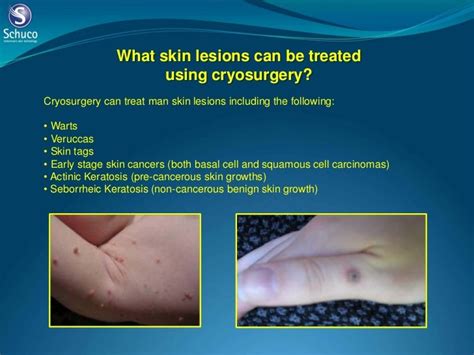 Cryosurgery