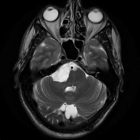 Epidermoid cyst (cerebellopontine angle) | Image | Radiopaedia.org