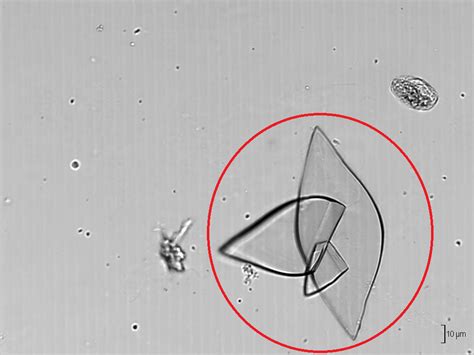 Types of Crystals Found In Human Urine and Their Clinical Significance ...