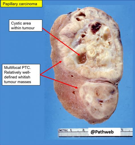 Thyroid – Papillary carcinoma – NUS Pathweb :: NUS Pathweb