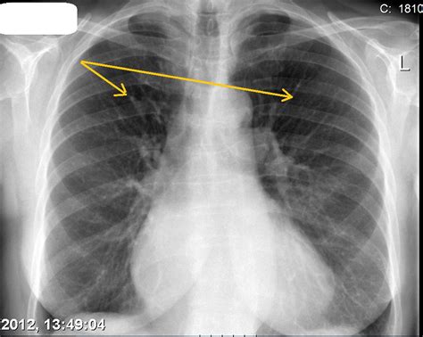 Pulmonary edema chest x ray - wikidoc