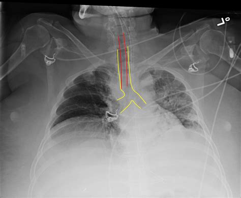 Endotracheal Tube Placement X Ray