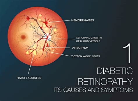 Diabetic Retinopathy Part 1: Its Causes and Symptoms | Fairfax VA ...