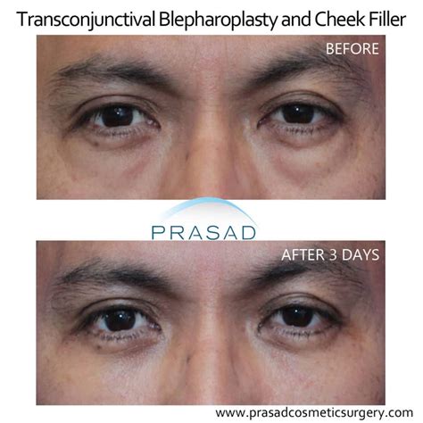 Eye Bag Surgery / Lower Blepharoplasty Recovery Process