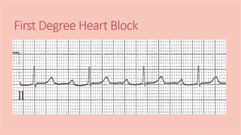 First Degree Heart Block Ekg Pictures to Pin on Pinterest - ThePinsta