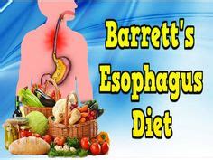 Barrett’s Esophagus