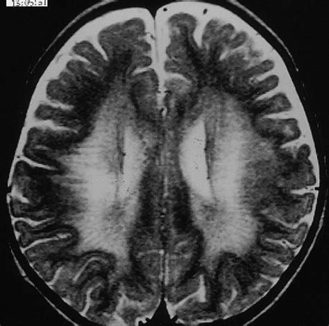 Leukodystrophy in Children: A Pictorial Review of MR Imaging Features ...