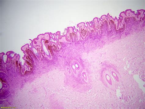 Congenital Melanocytic Nevus Histology