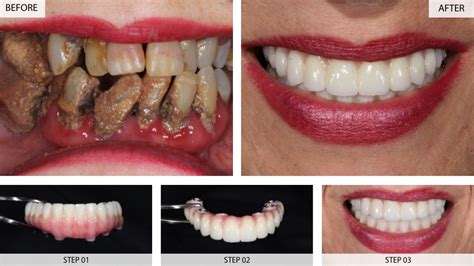 Tooth Implant Before After