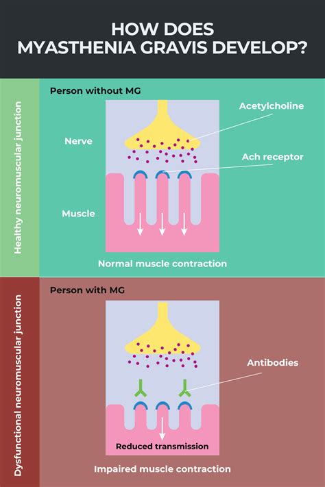 Myasthenia gravis: Everything you need to know | Myasthenia Gravis News