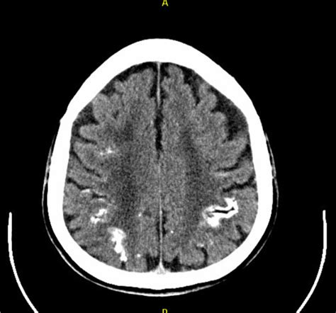 Head CT scan showing diffuse brain atrophy with cortical calcifications ...