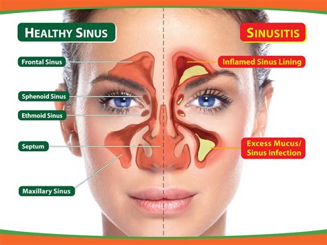 Sinusitis Treatment | Sinus Infection - Where Salt Therapy Is The Best ...