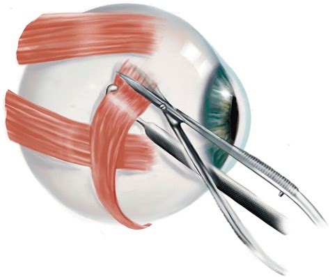 Disinsertion of inferior oblique muscle | Download Scientific Diagram