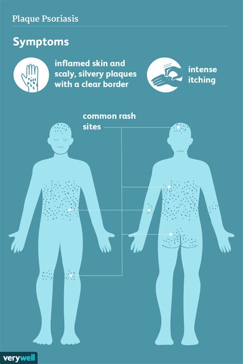 Signs and Symptoms of Plaque Psoriasis