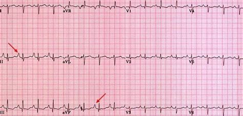 Right atrial enlargement