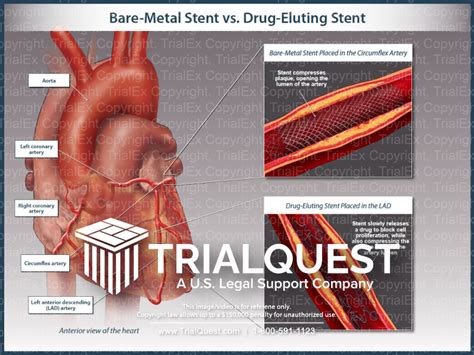 Bare-Metal Stent vs Drug-Eluting Stent - TrialExhibits Inc.