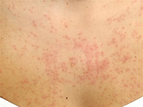 what is folliculitis - pictures, photos