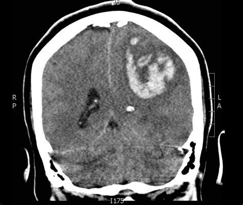 Brain Bleed CT Coronal. JETem 2017 - JETem