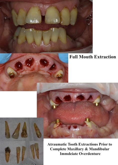 Infection one month after wisdom tooth extraction | healthlines