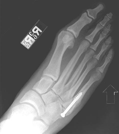 Failed Intramedullary Screw Fixation of a Proximal Fifth Metatarsal ...