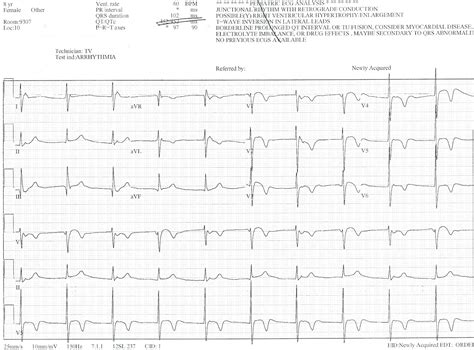 Pedi cardiology: EKG: Junctional Rhythm with Retrograde P waves...