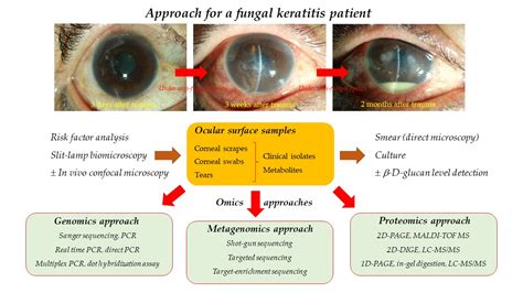 Fungal Corneal Ulcer Satellite Lesion