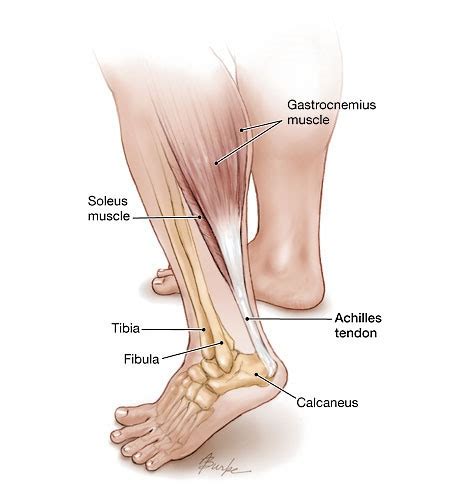 Achilles Tendinopathy; Nyeri Pergelangan Kaki Bagian Belakang