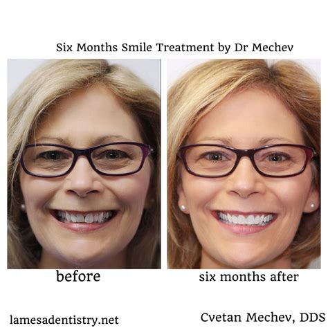 Six Month Smiles Braces offered in La Mesa Dental Center | Braces ...