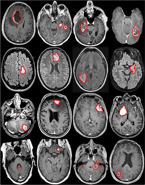 Brain Tumor Color Mri